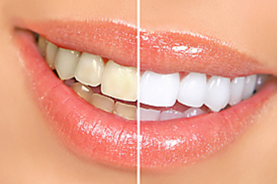 Ragyogó fehér fogak? 4 dolog, amit tudnod kell a fogfehérítésről