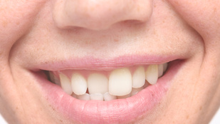 Mitől lesz szabálytalan a fogsor?