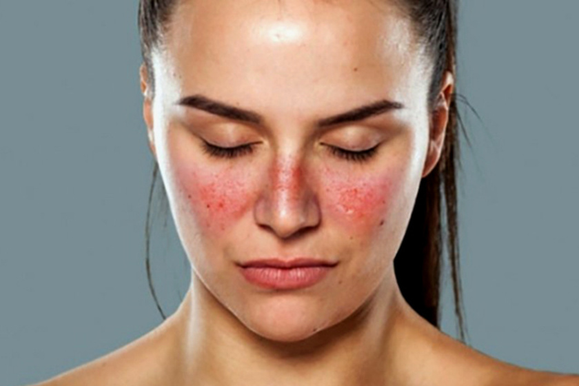 Csúnyán pirosodik az orr melletti bőr? Súlyos bőrbetegséget jelezhet