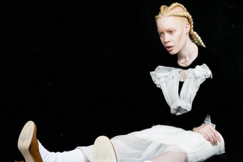 Gyerekként gyakran kinevették, most ő akar segíteni másokon: különleges szépség az albínó modell