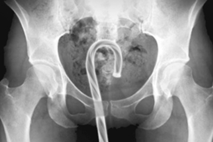 Bizarr röntgenképek: 7 tárgy, amit szexjátékszernek néztek