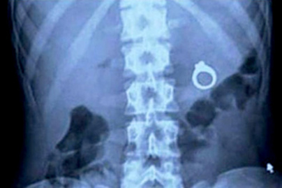 Eljegyzési gyűrű a röntgenképen!