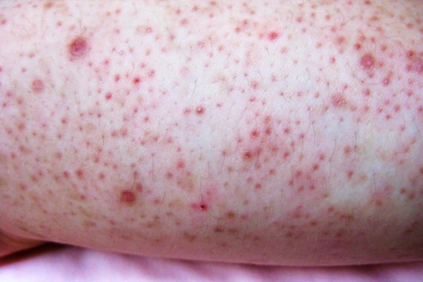 A bőr gombás megbetegedései | Kárpátalja