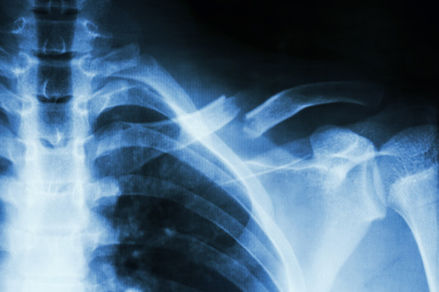 Csonttörés után így változik meg a test: 10 röntgenkép, amit nehéz elfelejteni