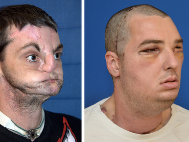 Másfél napos műtéttel kapott új arcot egy amerikai férfi