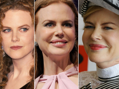 Így torzult el Nicole Kidman arca