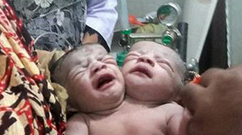 Kétfejű lány született Bangladesben