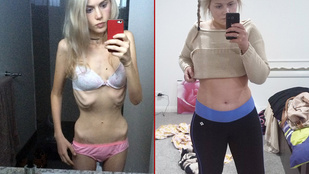 Először anorexiás volt, aztán enyhén túlsúlyos, majd 6 hónap alatt fogyott 40 kilót