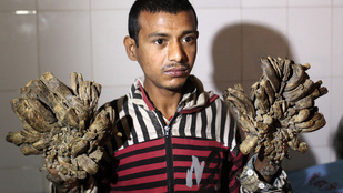 Megszabadítják ágaitól a bangladesi faembert