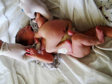 Szétválasztották a torzóval összenőtt afgán csecsemőt