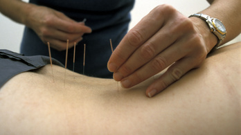 Az akupunktúra mégsem jó a hátfájásra