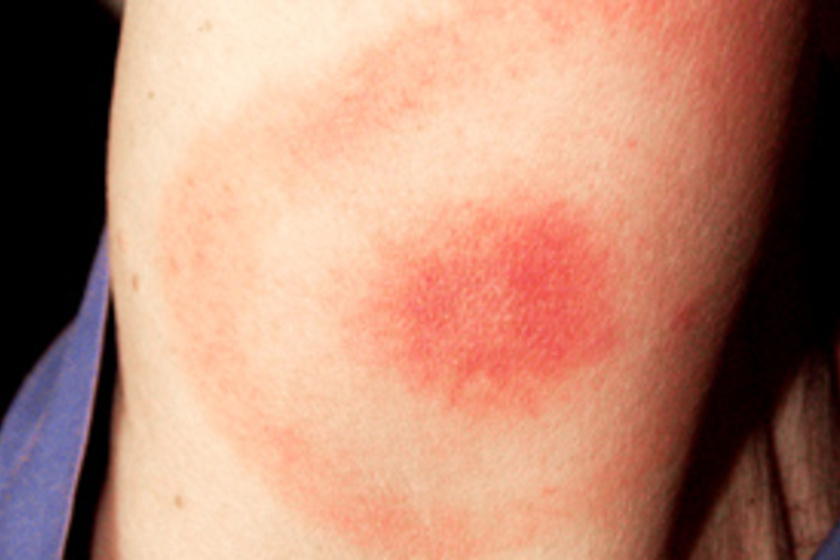 Lyme-kór: így néz ki a betegség jellegzetes tünete 