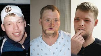 Tíz év után kapott új arcot egy amerikai férfi