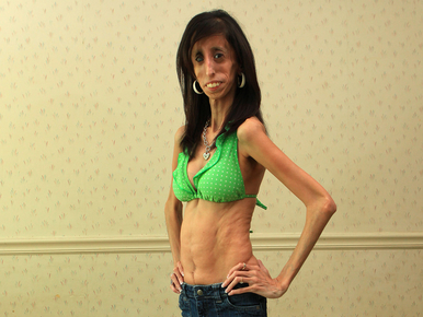 Nem anorexiás a világ legsoványabb nője