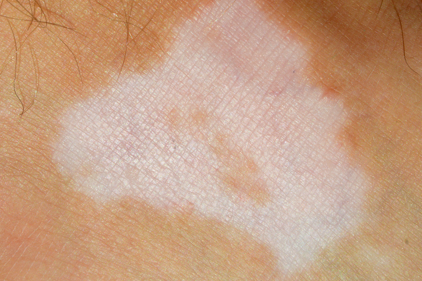 Terjedő fehér foltokat okoz a bőrön: autoimmun betegségek, amiktől megváltozik a külsőd