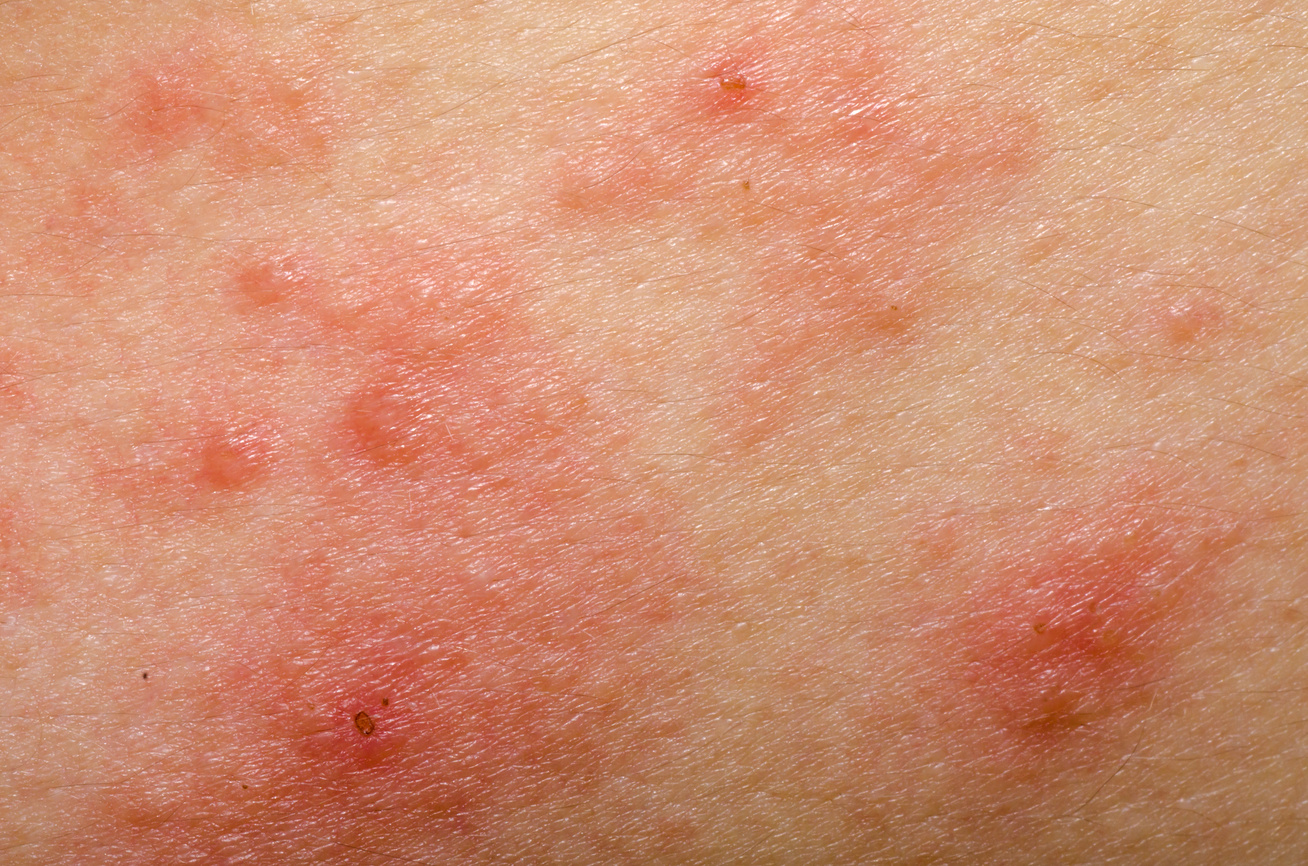 A bőrallergia tünetei és kialakulásának okai Fotó ekcéma a visszeres lábakon