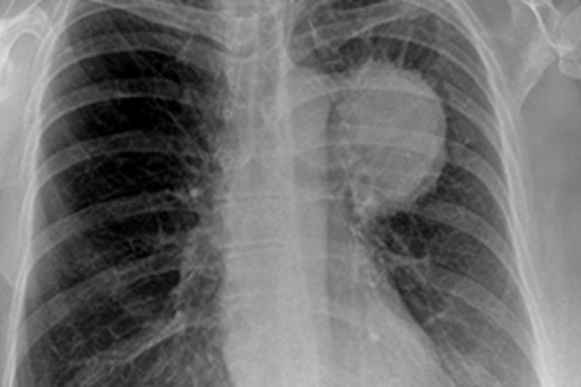 Képeken 3 gyakori rákfajta: ez ad okot félelemre a röntgenképen