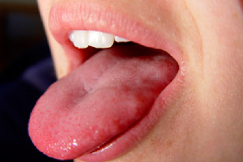 Repedések a nyelv okozza, kezelések, és mik azok