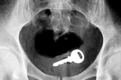 Az orvos is nevetett rajta! Képeken 6 vicces röntgenfelvétel!
