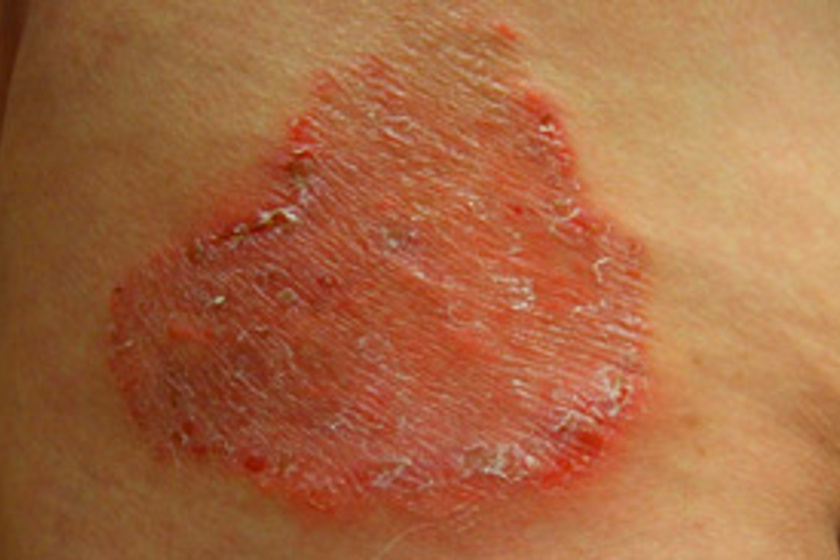 bőrbetegségek vörös foltok a bőrbetegségen fotó