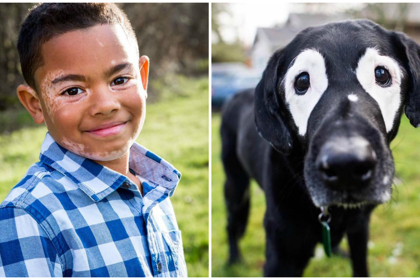 Csúfolták, és utálta a külsejét a vitiligós kisfiú - De új kutyája megtanította, hogy a különleges gyönyörű