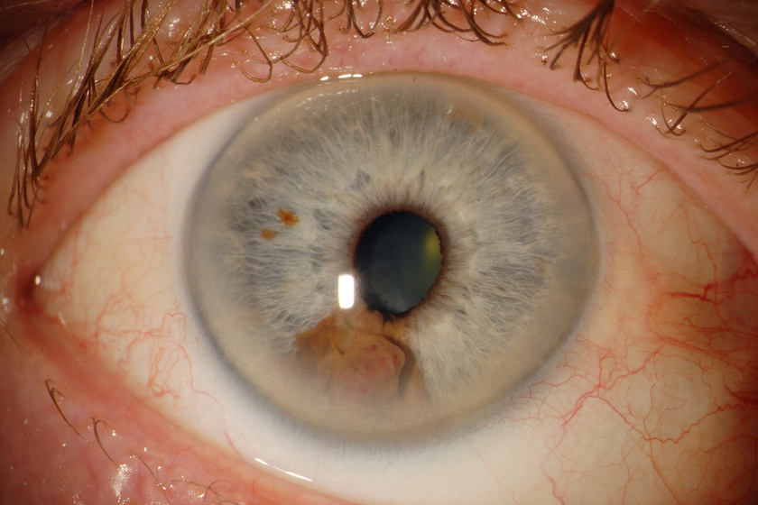 a kötőhártya-gyulladás károsíthatja a látást lymphogranulomatosis gyanúja