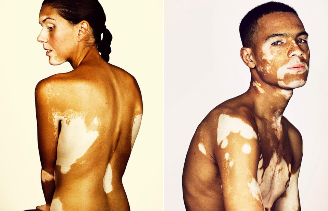 vitiligo kep cover
