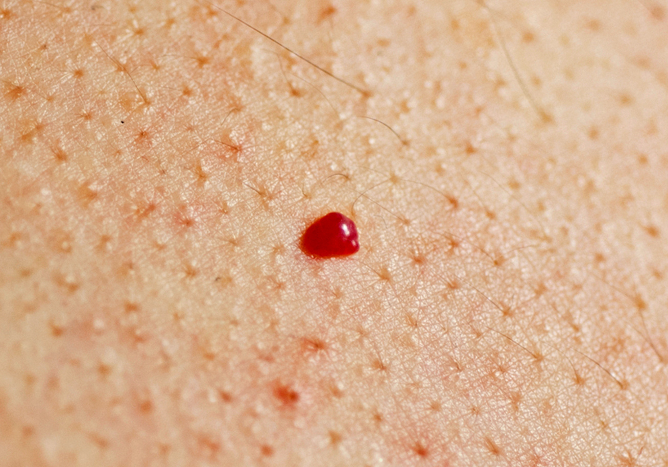Vörös foltok a bőrön: hogyan lehet megszabadulni a foltoktól - Herpesz
