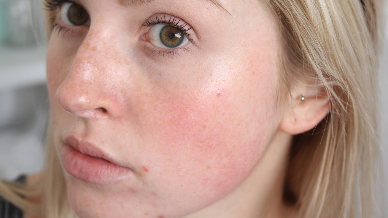 Viszkető arcbőr és kiütések | Bepanthen