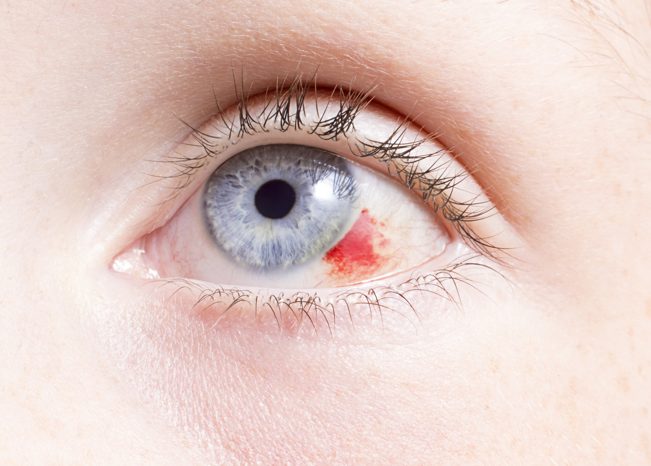 mit gyógyíthat a látás rövidlátással beteg