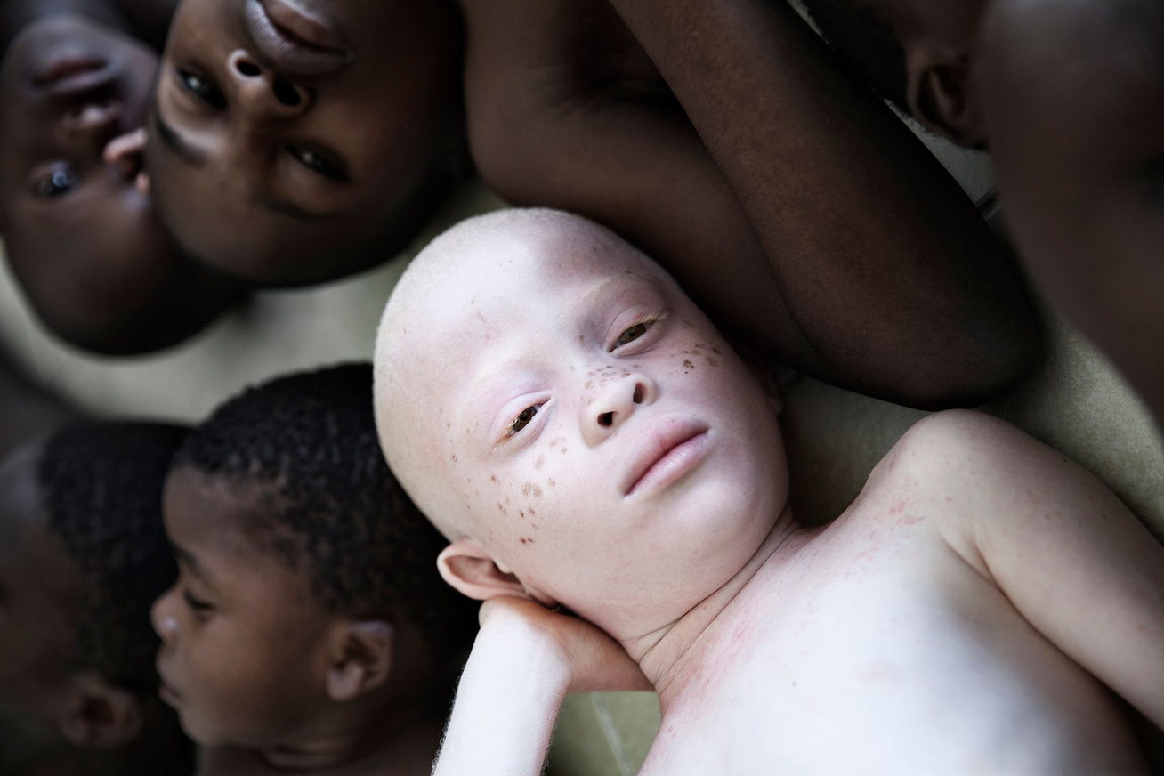 albino-kisgyerek