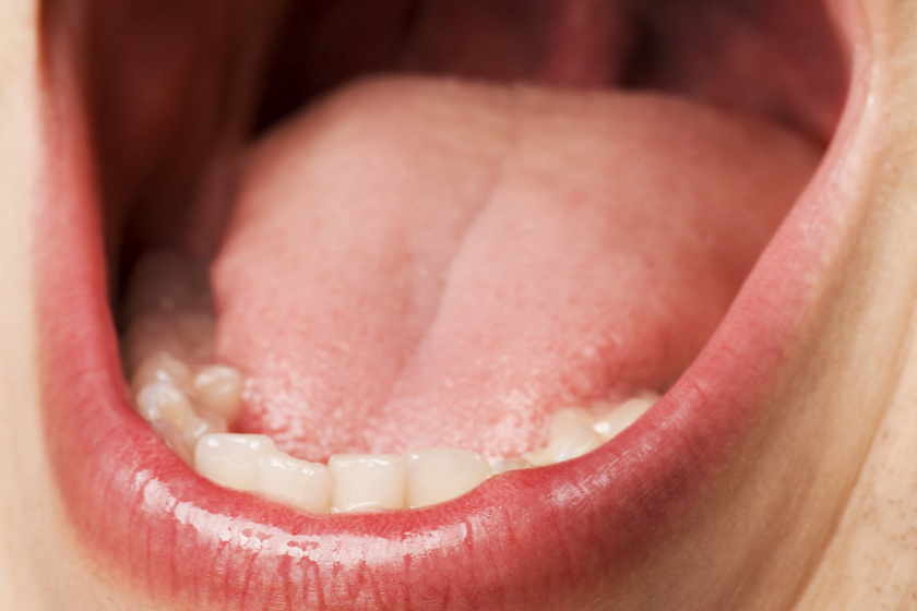 A rák jele vagy egyszerű seb? 10 elváltozás a szájban, amit fontos felismerni