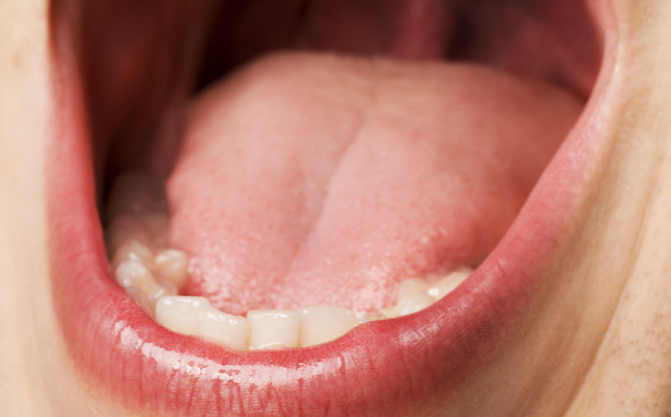 Ajakráktól a nyelvrákig: mit kell tudni a szájüregi daganatokról? - HáziPatika