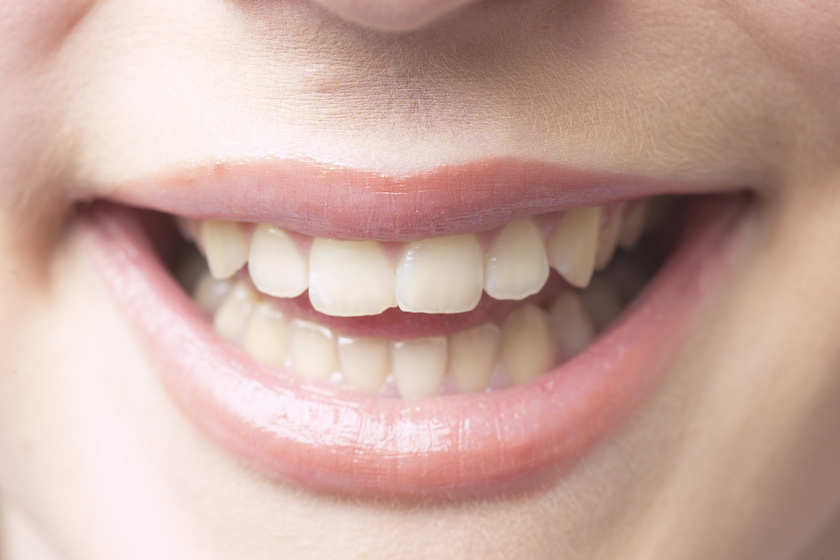 Elszíneződés a fogakon: több típusa is lehet, és mindegyik mást jelent