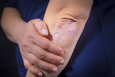 Megvastagodott bőr: ezt kell tudni a hiperkeratosisról - EgészségKalauz
