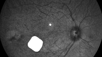 Időskori látásromlást javít egy bionikus szem