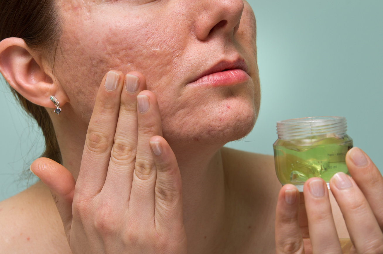 Hogyan lehet eltávolítani a vörös foltok akne után az arcon - Bőrgyulladás November