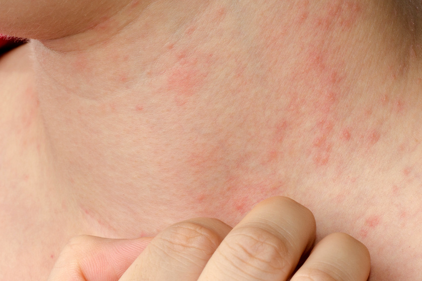 Súlyos betegségre utalhatnak a piros foltok és a bevérzések a bőrön - Sokan nem veszik észre a tüneteket
