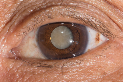 Az UV-sugárzás hatásai a szemre: fokozza a szürke hályog kockázatát