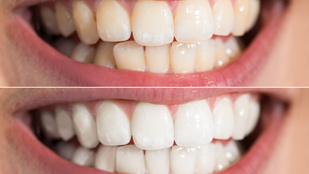 Mitől lesz fehér a fogad? 3 megoldás közül választhatsz!