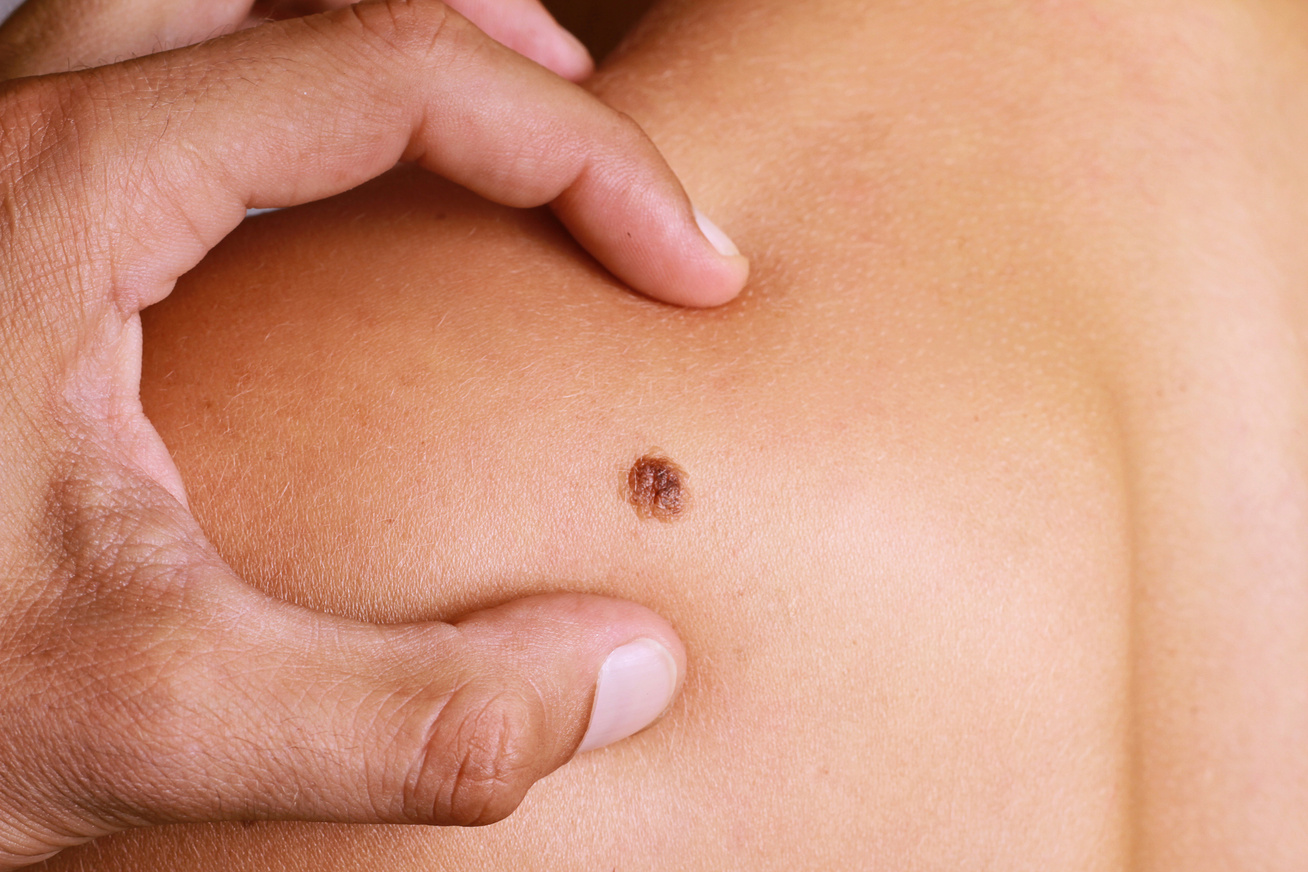 súlycsökkenés rosszindulatú melanomával
