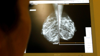 Először sikerült daganatmentessé tenni egy áttétes mellrákban szenvedő nőt