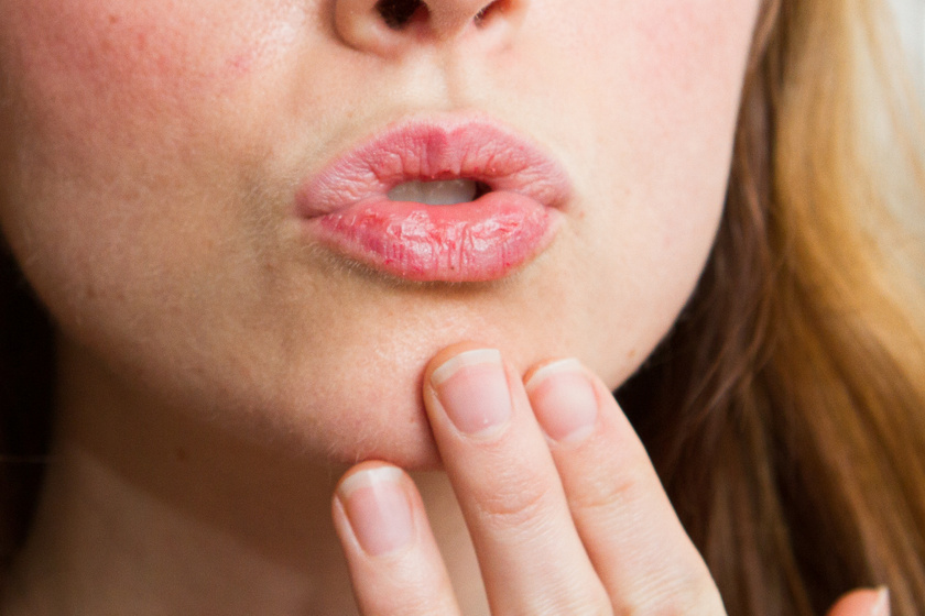A cserepes ajkak és a száraz bőr is tünet lehet: a felnőttkori cukorbetegség 8 legfontosabb tünete