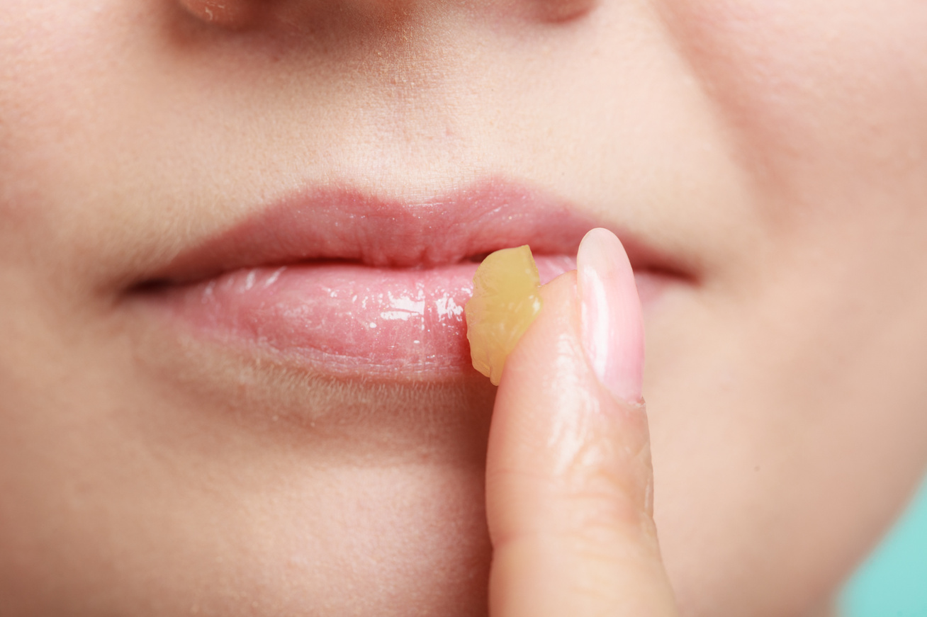 Veszít zsírt a szájból - Hogyan lehet zsírokat veszíteni az ajkak körül
