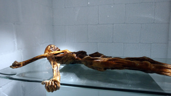 Az 5000 éves Ötzinek sok betegsége volt, de kapott gyógykezelést
