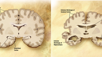 Mesterséges intelligencia segít az Alzheimer korai felismerésében
