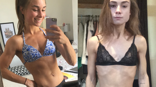 Eltanulta a szüleitől az egészséges életmódot, de az anorexiáig túlzásba vitte