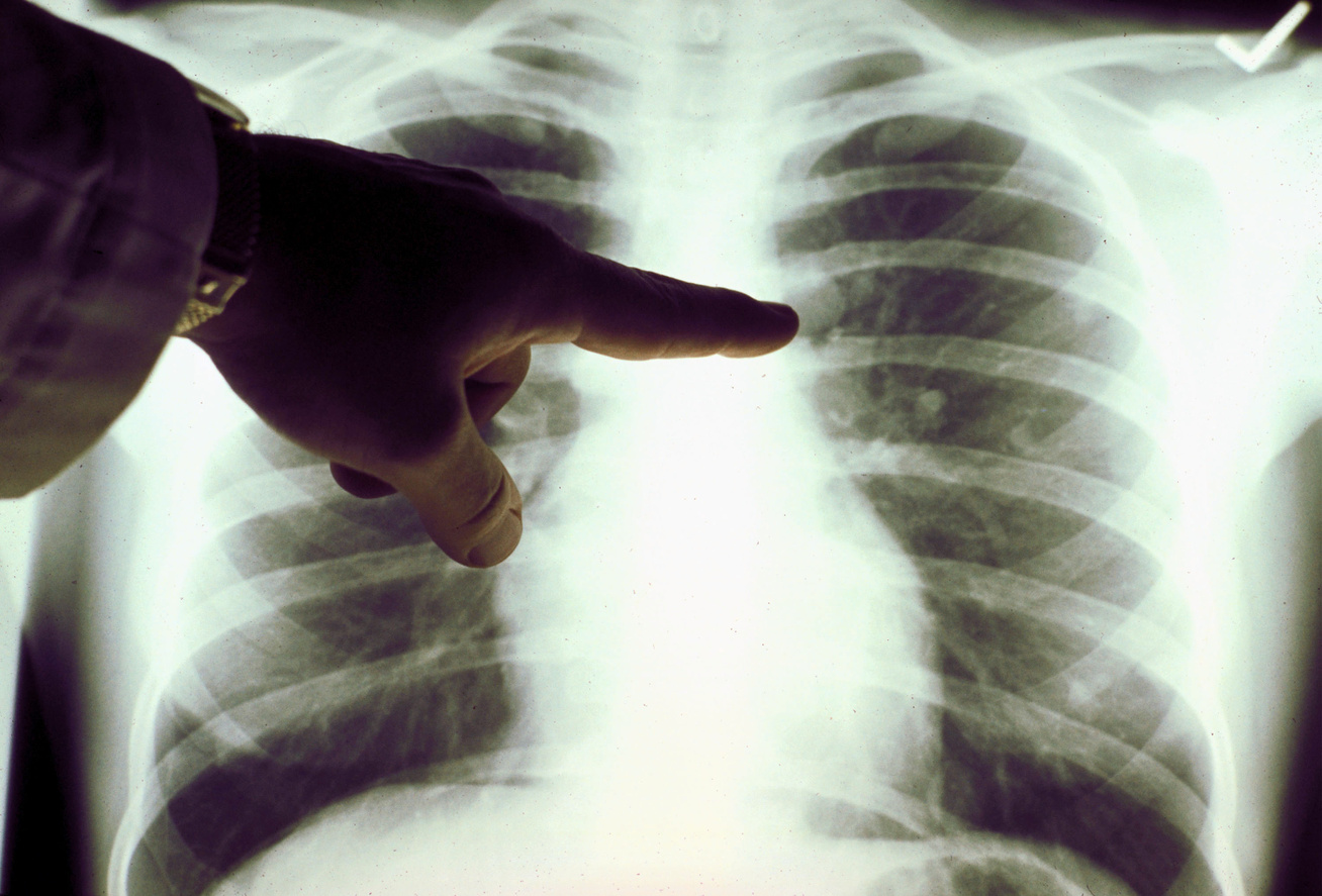 Hogyan kezelhető sikeresen egy négyes stádiumú tüdődaganat? - Harcosok Klubja videón