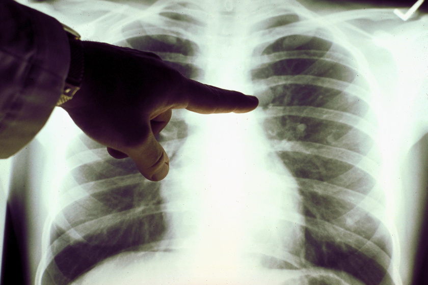 A tüdőrák legelső tünetei és a jövő gyógymódjai: nagyon fontos a korai diagnózis