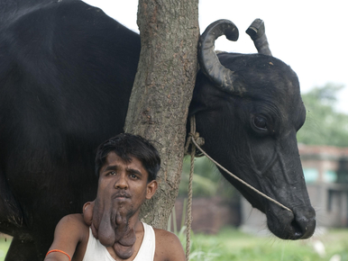 Műtétje után csajozna az indiai elefántember